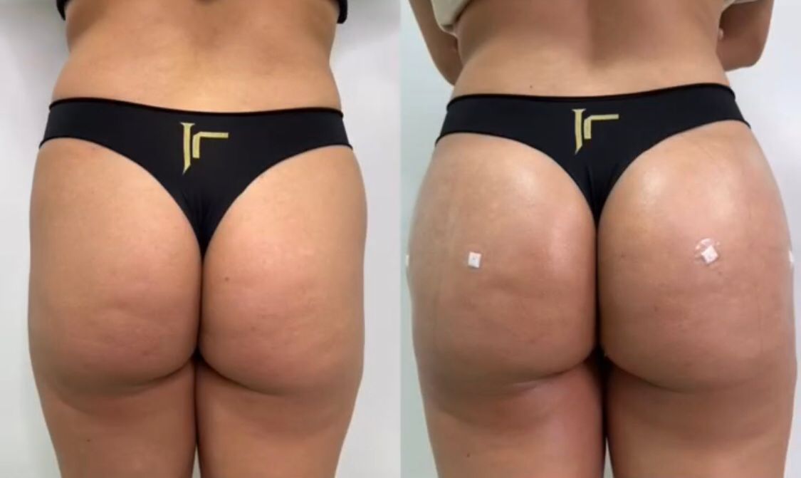 Antes e depois do método de harmonização de glúteos