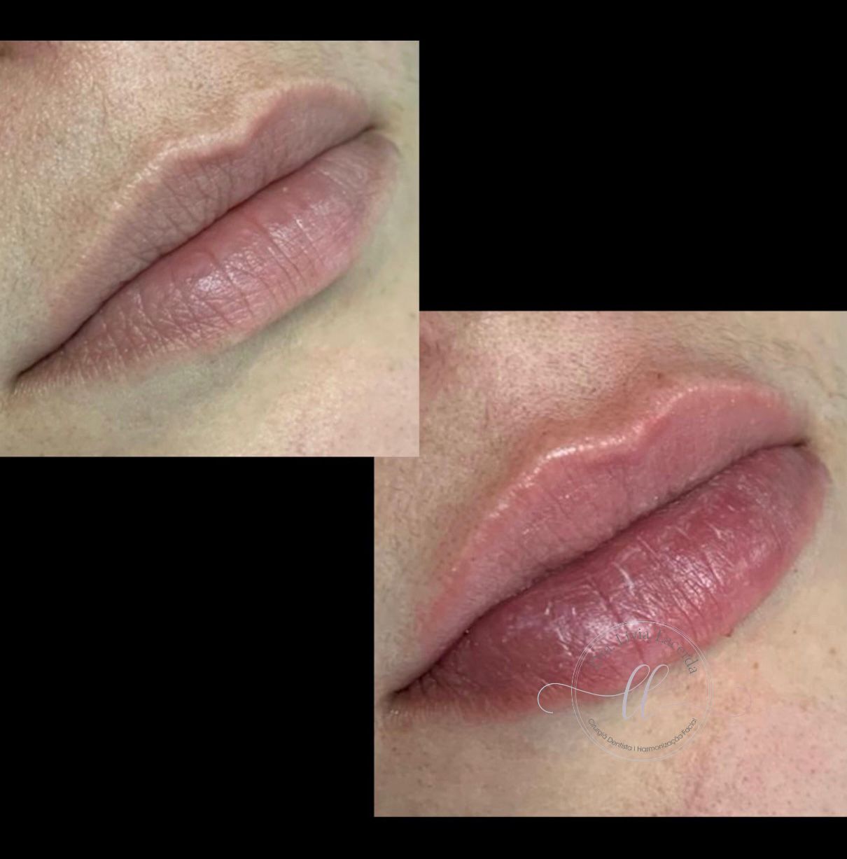 preenchimento labial