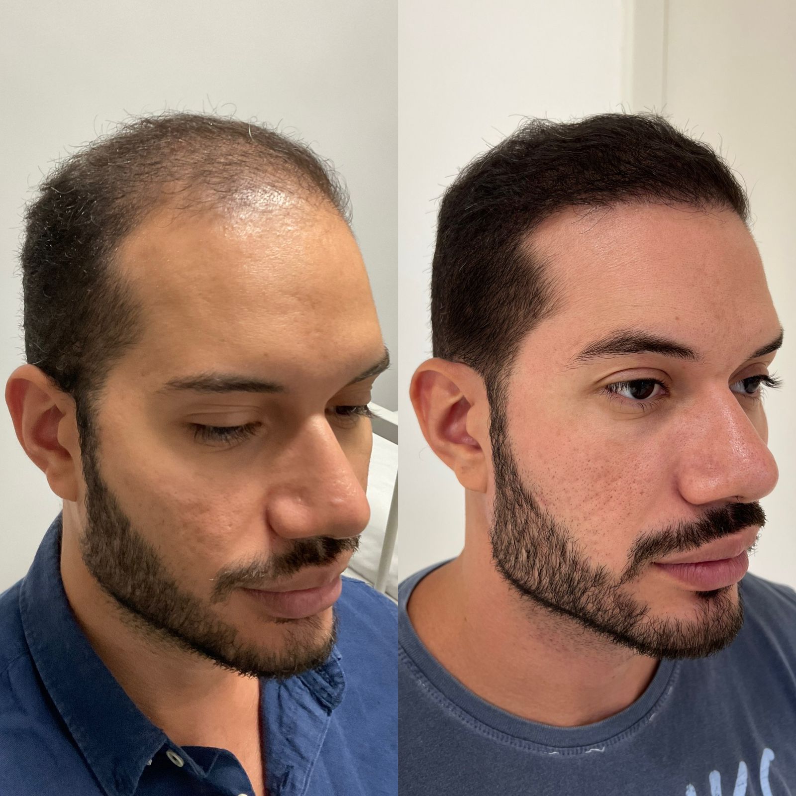 Antes e depois do procedimento realizado por Dr. Pablo Maciel
