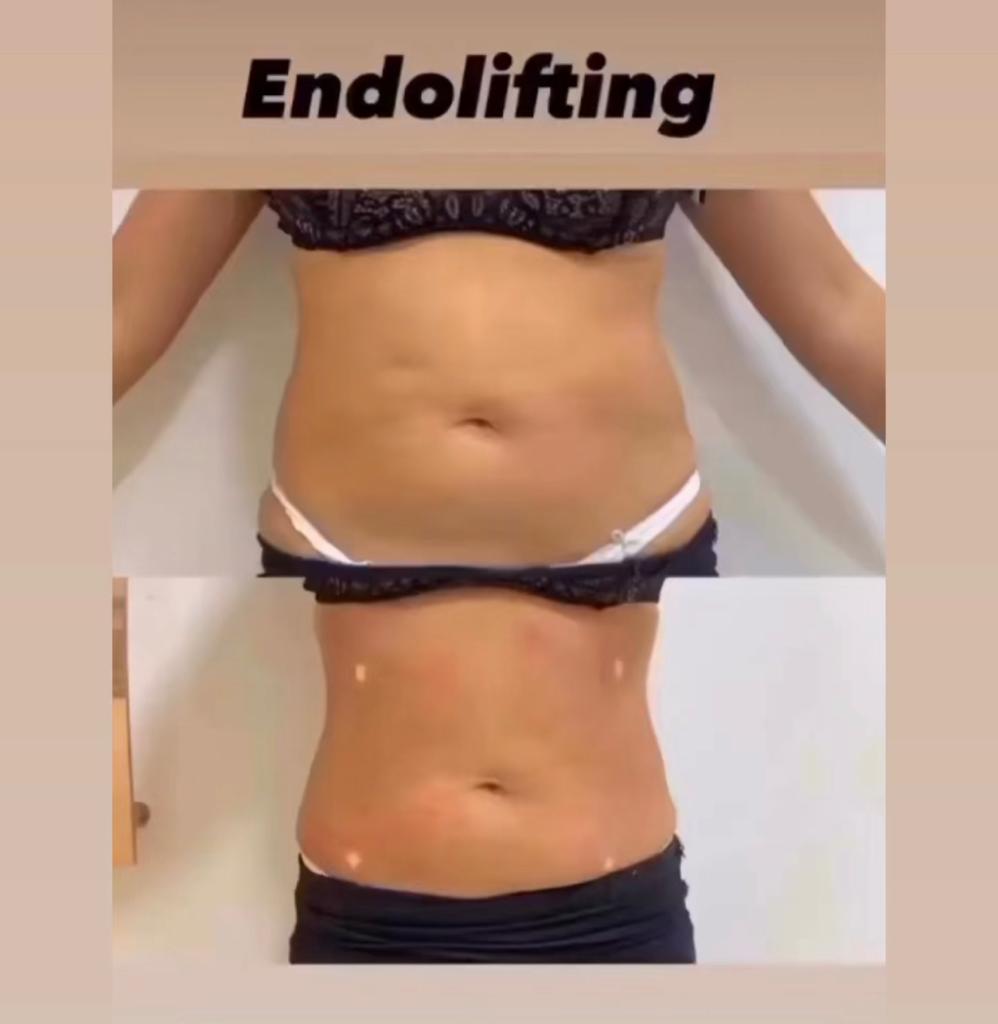 Endolifting