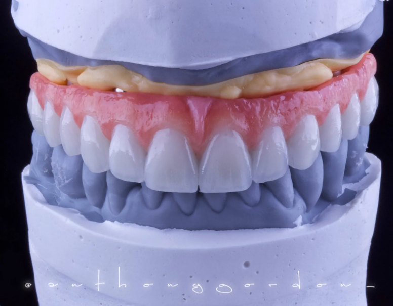 implantes-dentarios-tipo-protocolo